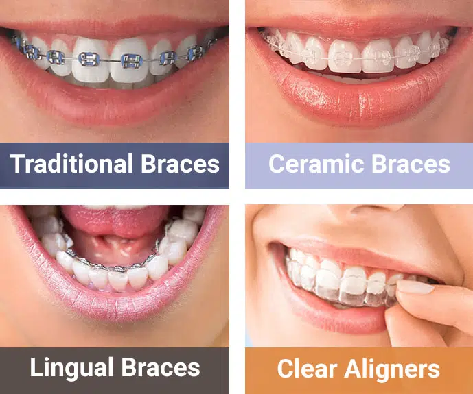 Types-of-Dental-Braces