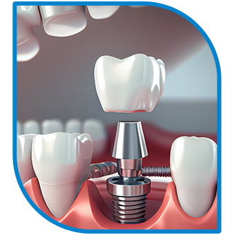 dental implants 1