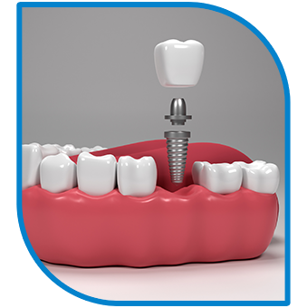 dental implants 2